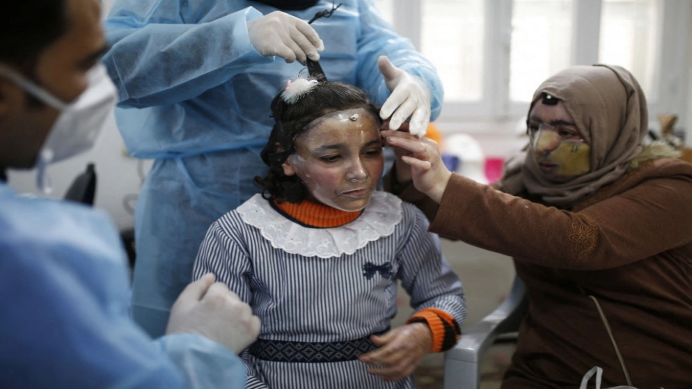 أقنعة بلاستيكية ثلاثية الأبعاد تمنح الأمل لضحايا حروق الوجه في غزة