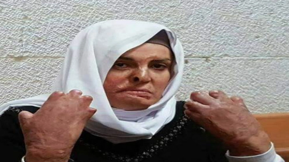 السجن يزيد آلام حروق الأسيرة الفلسطينية إسراء جعابيص